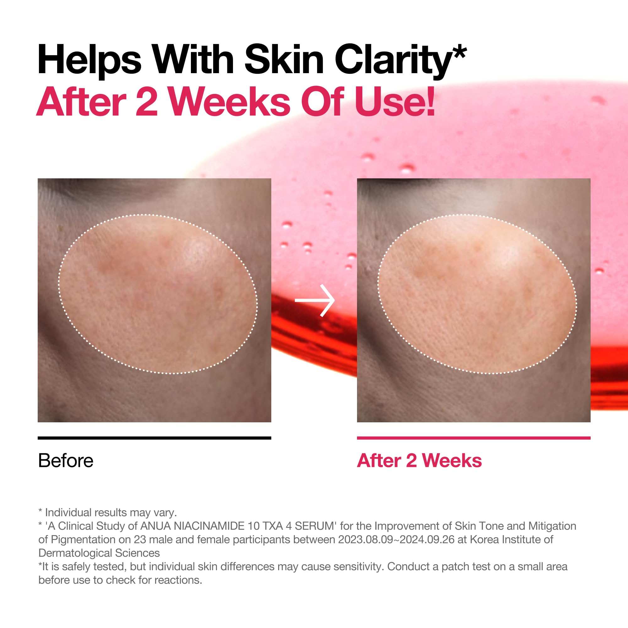 ANUA Niacinamide 10 + TXA 4 Serum, Hyaluronic Acid, Tranexamic acid, Facial Serum for Glass Skin, Clarifying, Radiant Complexion with Natural Color, Korean Skin Care (30ml /1.01 fl.oz)